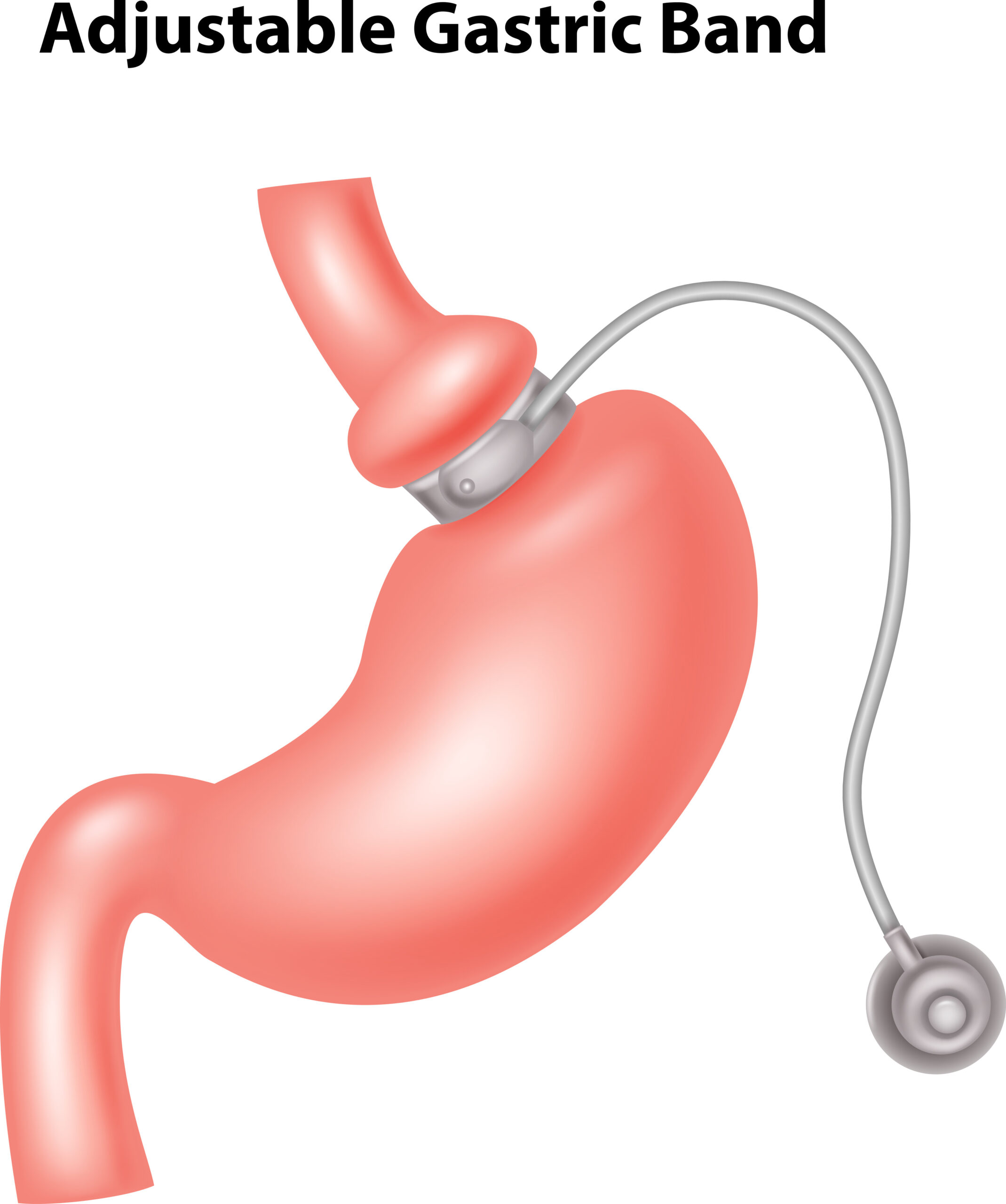 gastric banding treatment