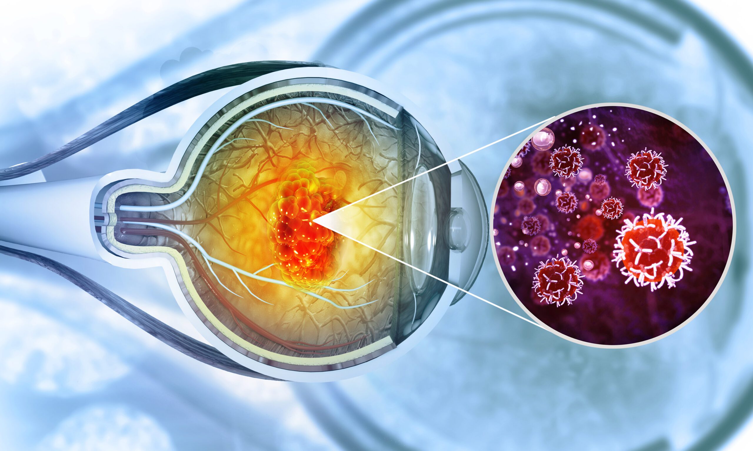 ocular tumour treatment