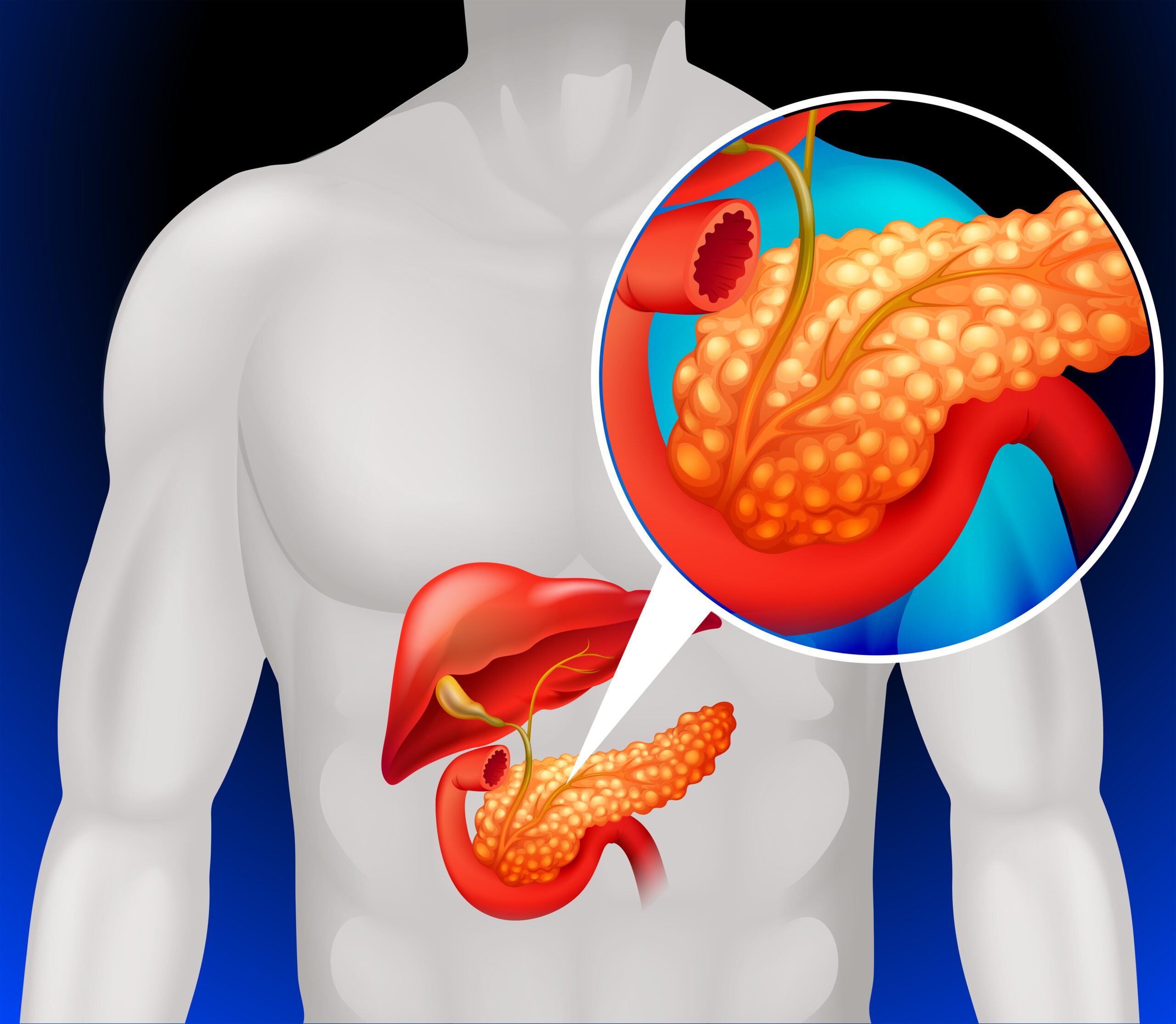 pancreatic cancer treatment