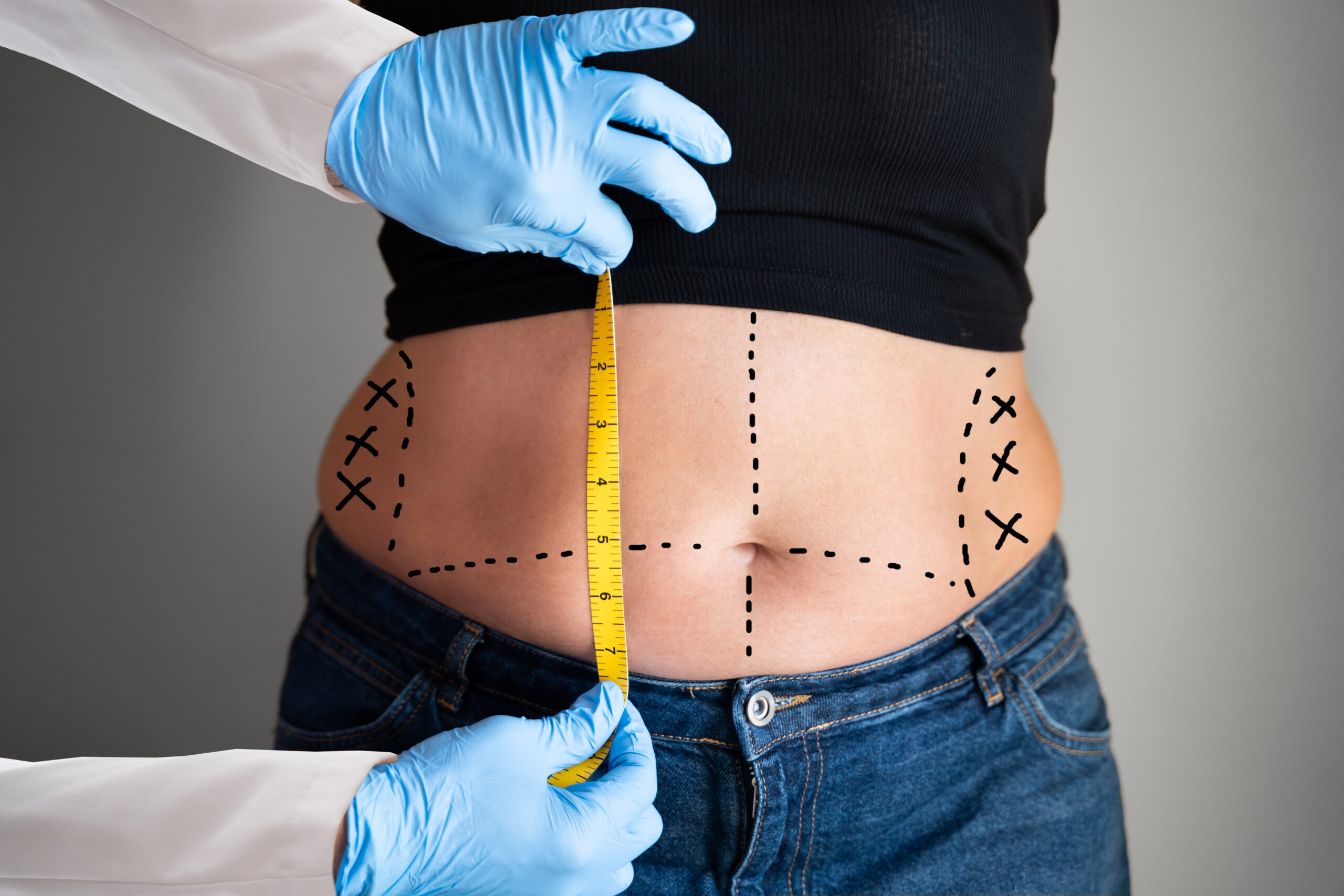 abdominoplasty treatment