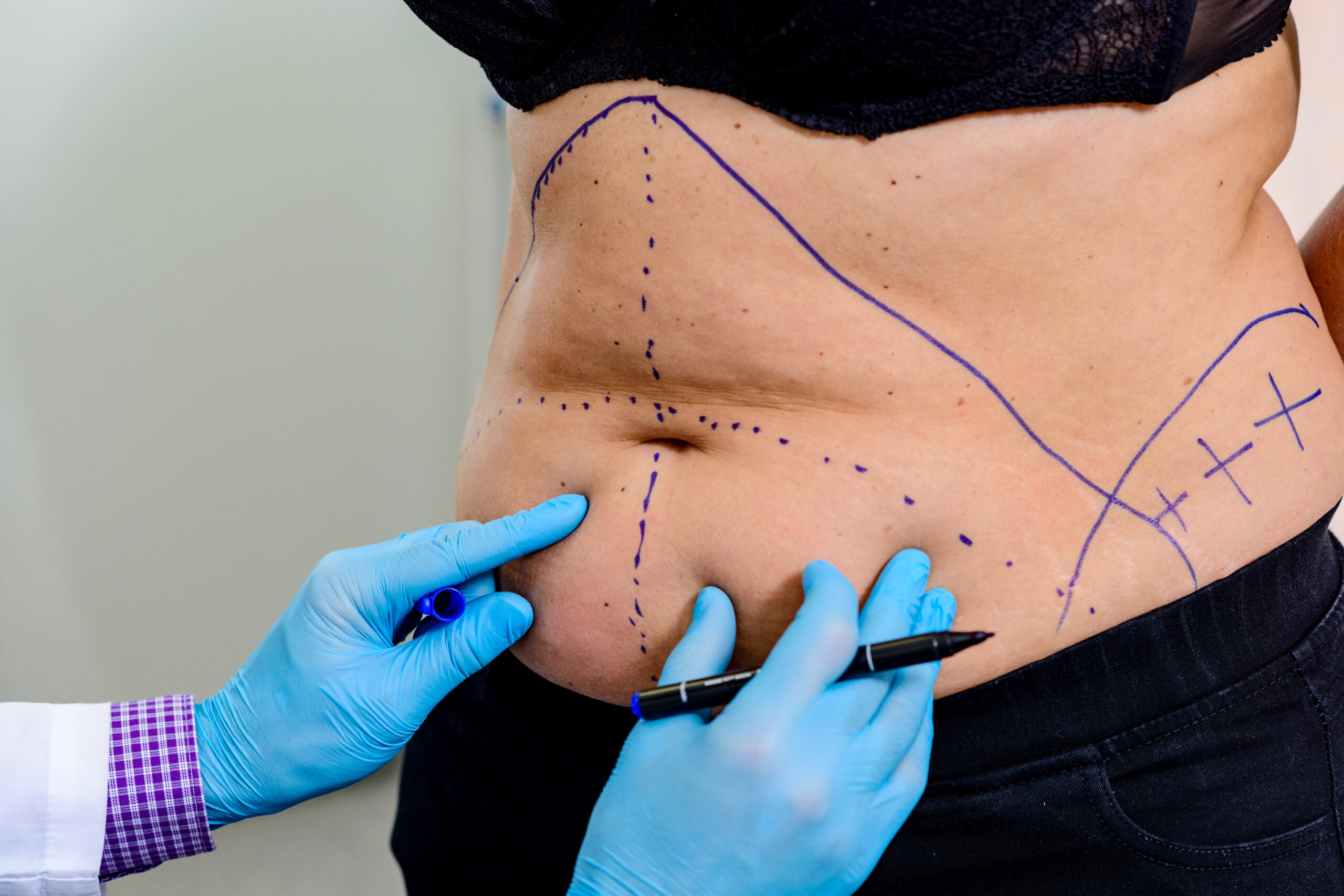 liposuction treatment